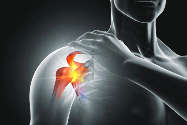 Shoulder joint after joint replacement