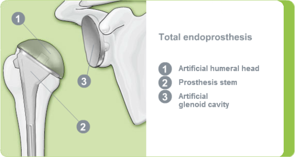 Illustration of a total shoulder endprosthesis