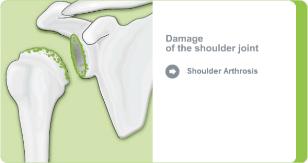 Illustration of a shoulder joint with shoulder arthrosis