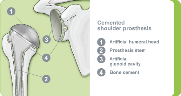 Illustration of a cemented shoulder prosthesis
