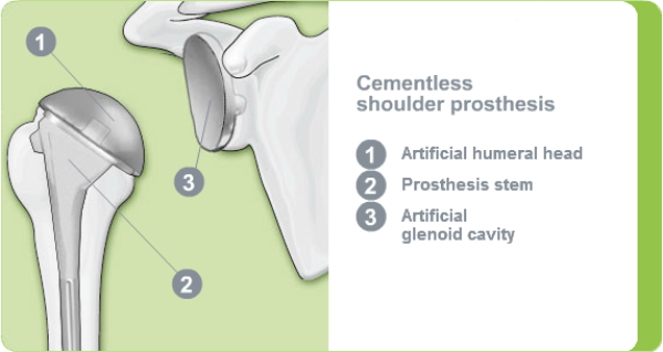 Illustration of a cementless shoulder prosthesis