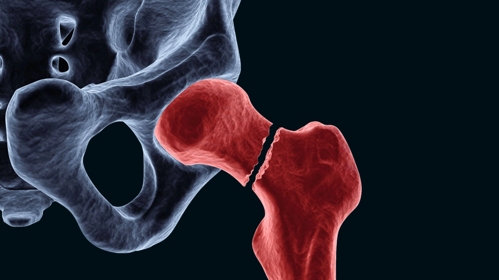 Fractured neck of femur (FNOF)