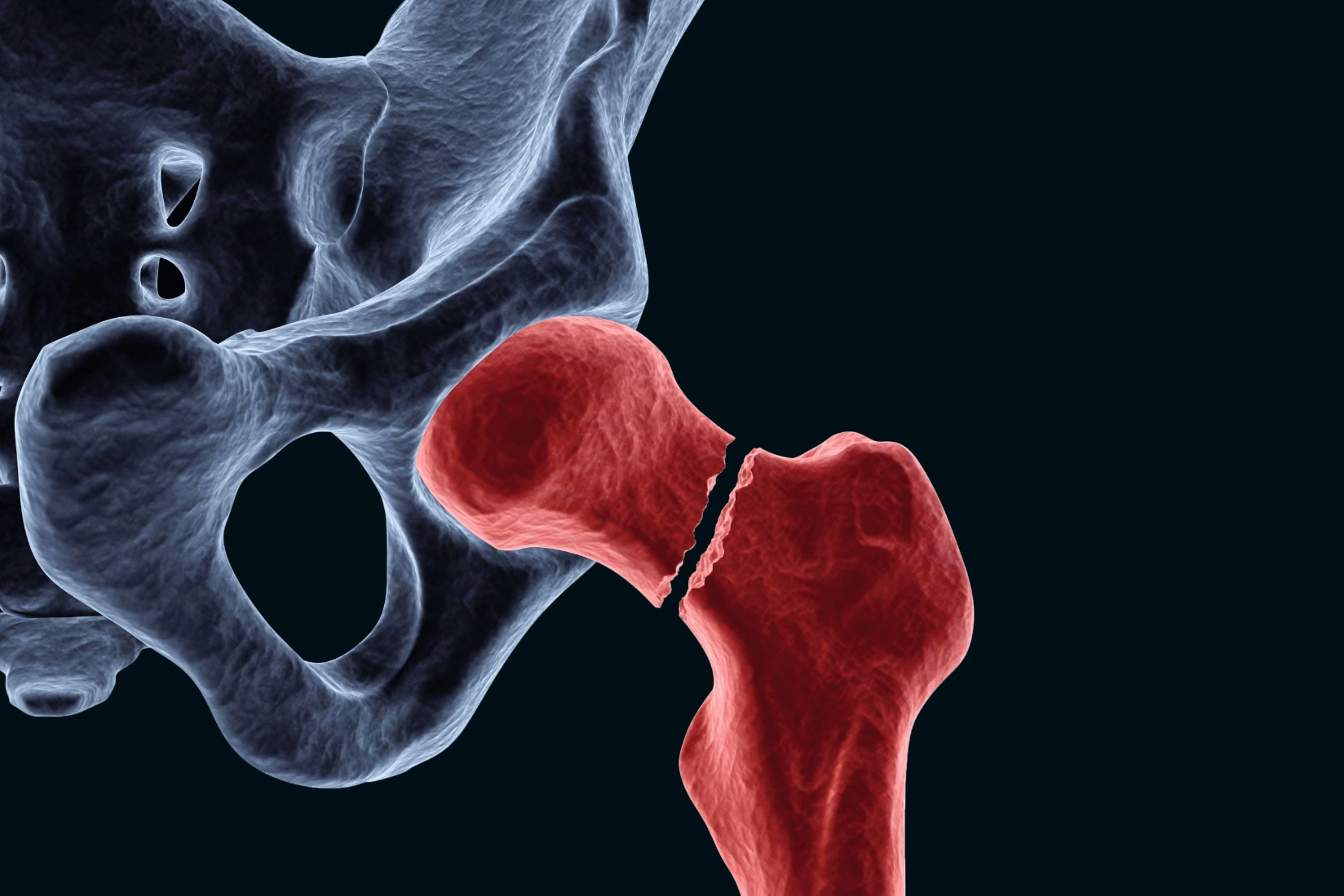 Fractured neck of femur (FNOF)