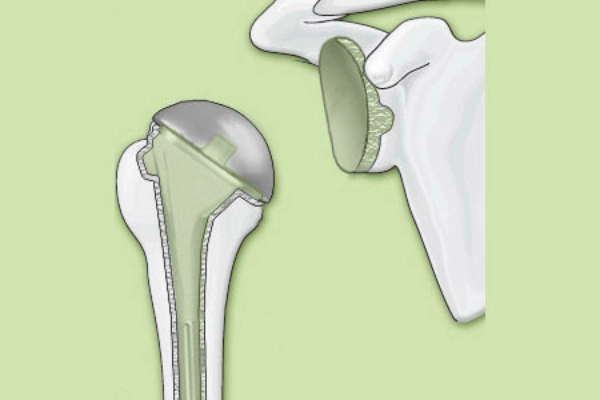 Illustration zementierte Schulterendoprothese