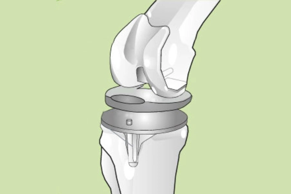 Illustration eines Knieoberflächenersatzes