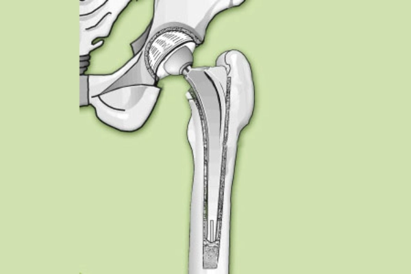 Illustration of a cemented hip replacement