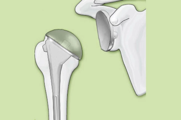 Illustratrion einer Totalendoprothese des Schultergelenks