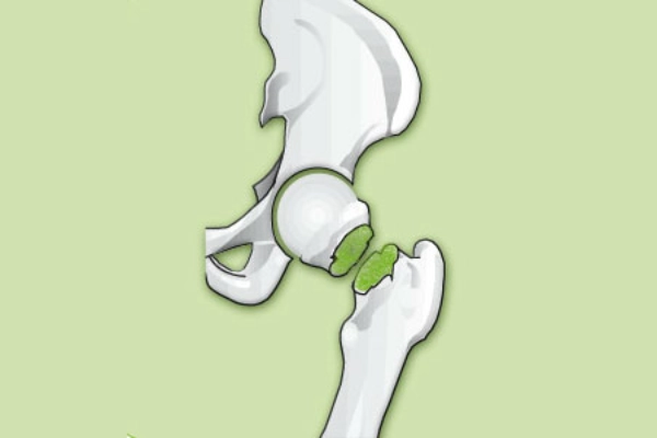 Illustration eines Hüftgelenks mit Oberschenkelhalsbruch