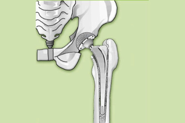 Illustration einer Totalendoprothese des Hüftgelenks