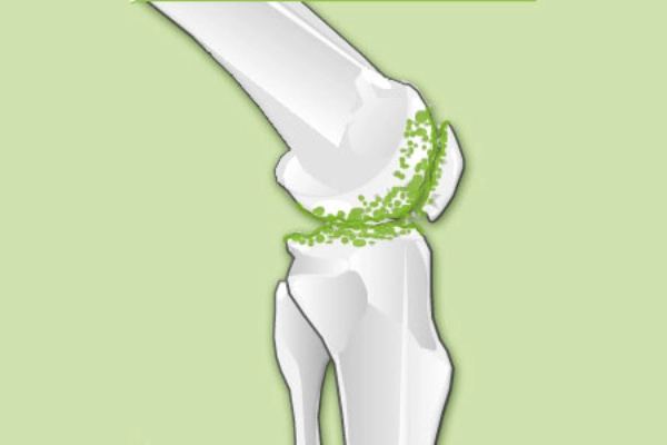 Illustration of a knee joint with genoarthrosis
