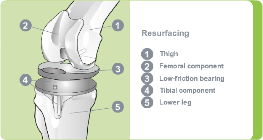 Artificial Knee Joint