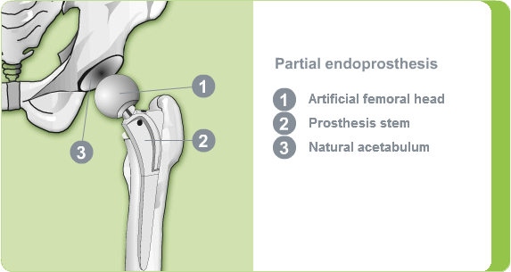 Illustration: partial hip endoprosthesis