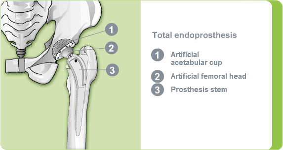 Illustration: total hip endoprosthesis
