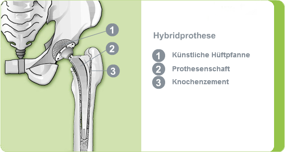 Illustration: Hybridprothese des Hüftgelenks