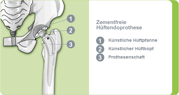 Illustration: zementfreie Hüftendoprothese