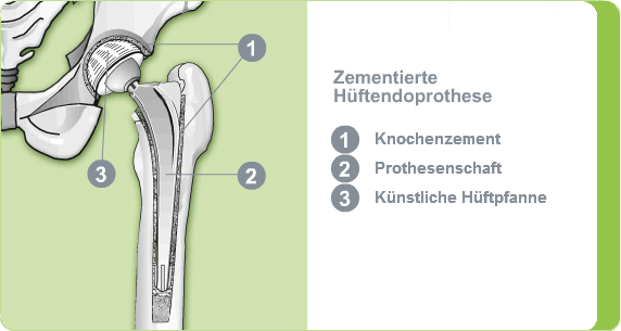 Illustration: zementierte Hüftendoprothese