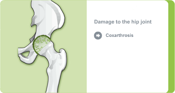 Illustration: Damage to the hip joint due to coxarthrosis