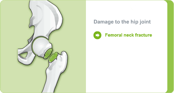 Illustration: Damage to the hip joint due to femoral neck fracture