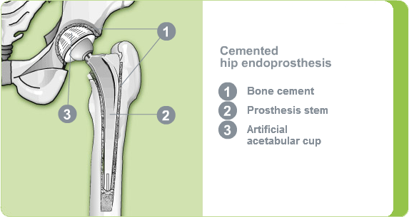 Illustration: cemented hip endoprosthesis