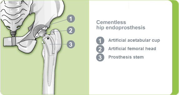 Illustration: cementless hip endoprosthesis