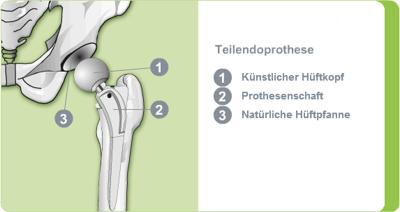 Illustration: Teilendoprothese des Hüftgelenks