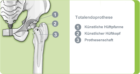 Illustration: Totalendoprothese des Hüftgelenks