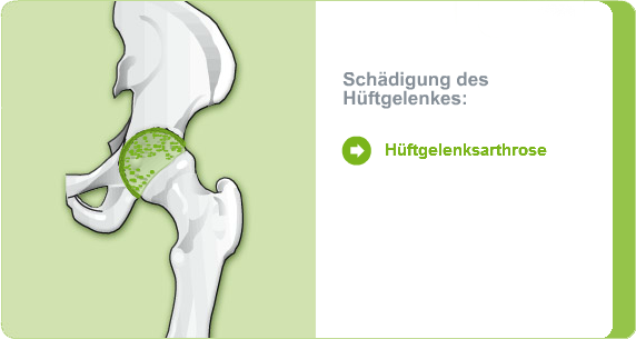 Illustration: Schädigung des Hüftgelenks durch eine Hüftgelenksarthrose