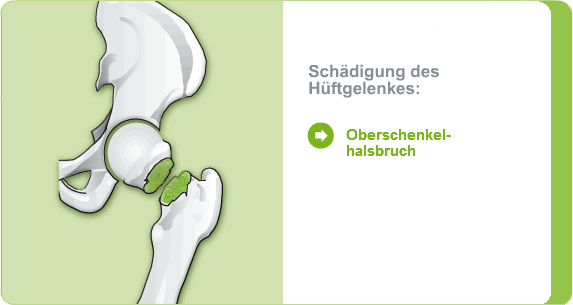 Illustration: Schädigung des Hüftgelenks durch Oberschenkelhalsbruch