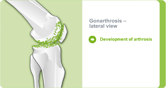 Illustration: Gonarthrosis - lateral view