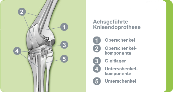 Illustration: Achsgeführte Knieendoprothese