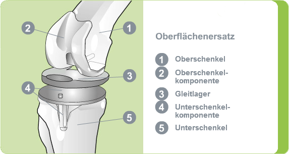 Illustration: Oberflächenersatz Kniegelenk