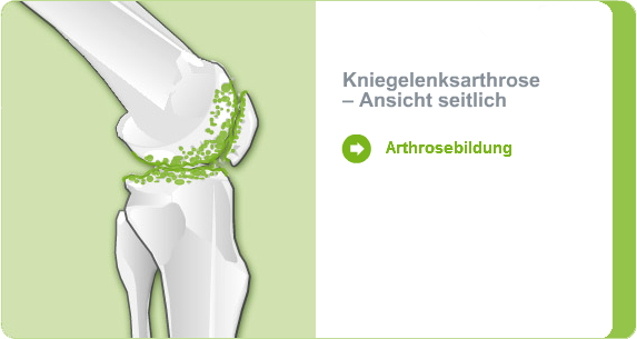 Illustration: Kniegelenksarthrose - Ansicht seitlich