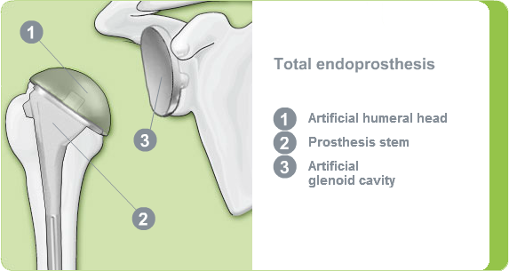 Illustration: total shoulder endprosthesis