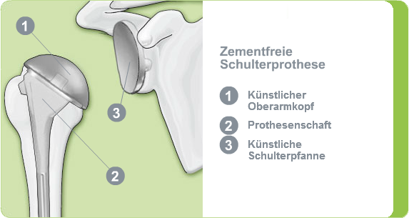 Illustration: zementfreie Schulterendoprothese
