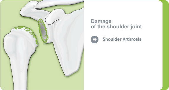Illustration: shoulder joint with shoulder arthrosis