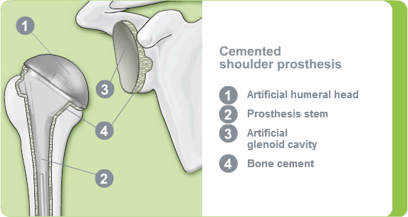 Illustration: cemented shoulder prosthesis