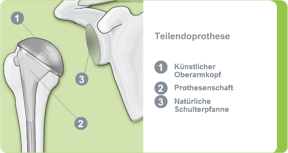 Illustration: Teilendoprothese des Schultergelenks