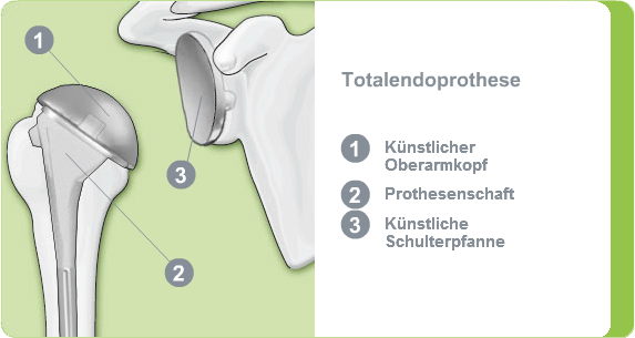 Illustration: Totalendoprothese des Schultergelenks