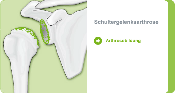 Illustration: Schultergelenksarthrose