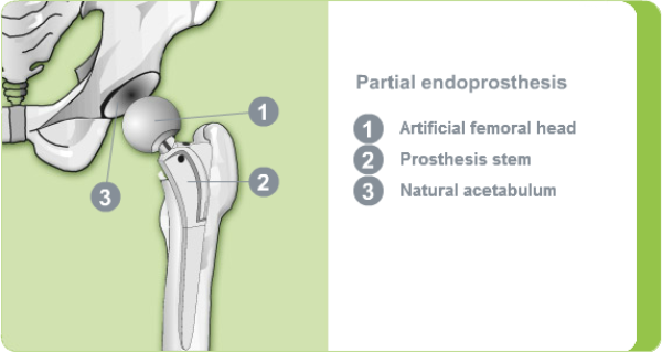 Partial endoprosthesis