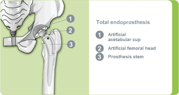 Total endoprosthesis