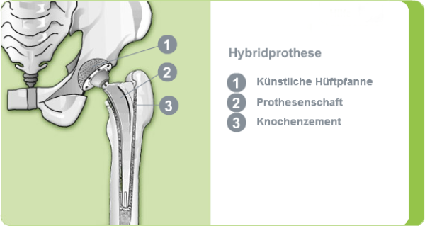 Hybridprothese