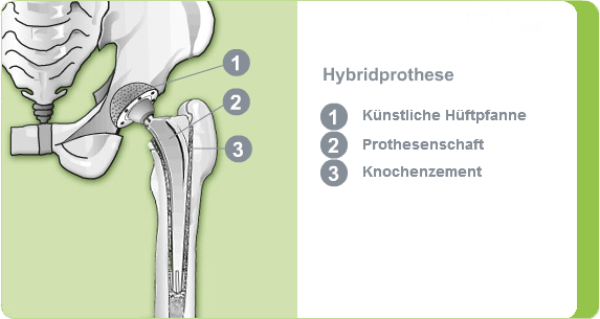 Illustration einer Hybridprothese des Hüftgelenks