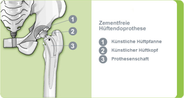 Illustration einer zementfreien Hüftendoprothese