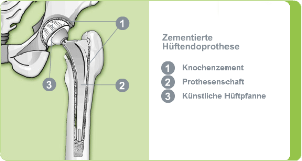 Illustration einer zementierten Hüftendoprothese