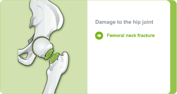 Damage to the hip joint due to femoral neck fracture