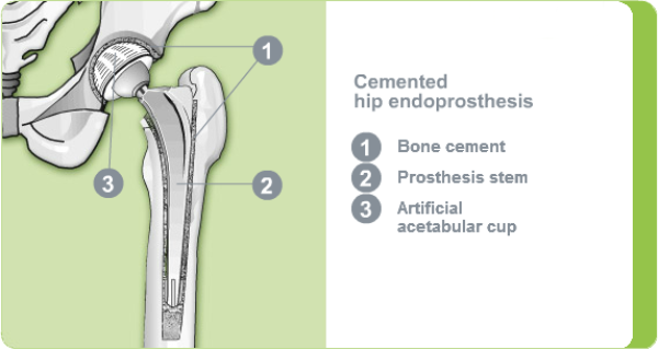 Cemented hip endoprosthesis