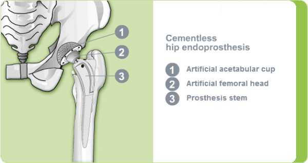 Cementless Hip Endoprosthesis