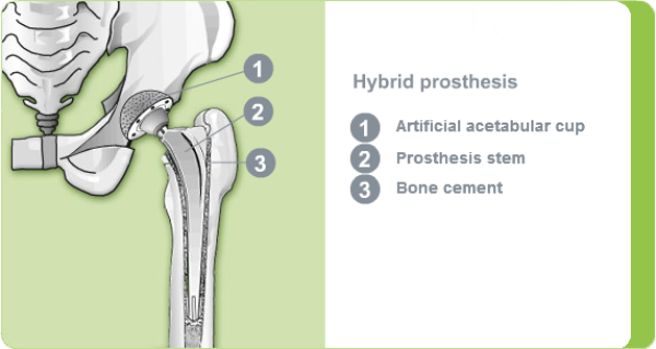 Hybrid prosthesis