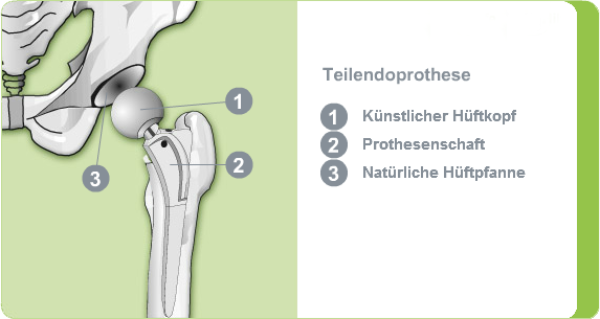 Illustration einer Teilendoprothese des Hüftgelenks